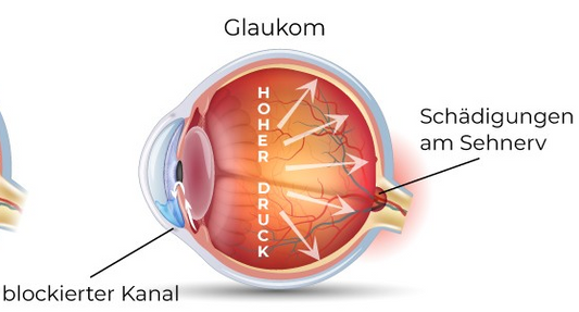 Grüner Star (Glaukom): Ein unsichtbarer Feind des Sehens